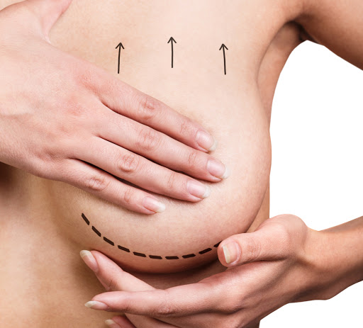 Procedimento de Mastopexia